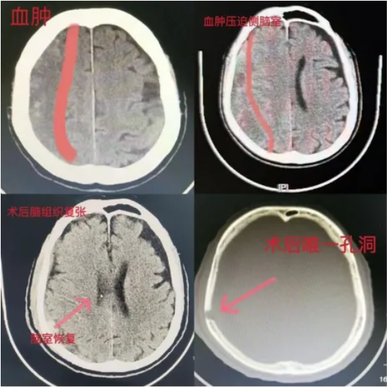 【健康科普】警惕老年人的沉默殺手，認(rèn)識(shí)慢性硬膜下血腫